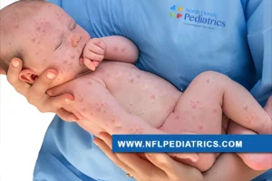 north-florida-pediatrics-measles-baby