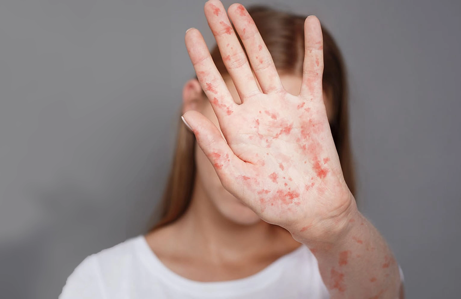 MMR vaccines: Young female ashamed of having measles North Florida Pediatrics 2026