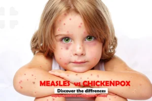 chickenpox-vs-measles+discover the differences+North Florida Pediatrics+near lake city,+mmr vaccines