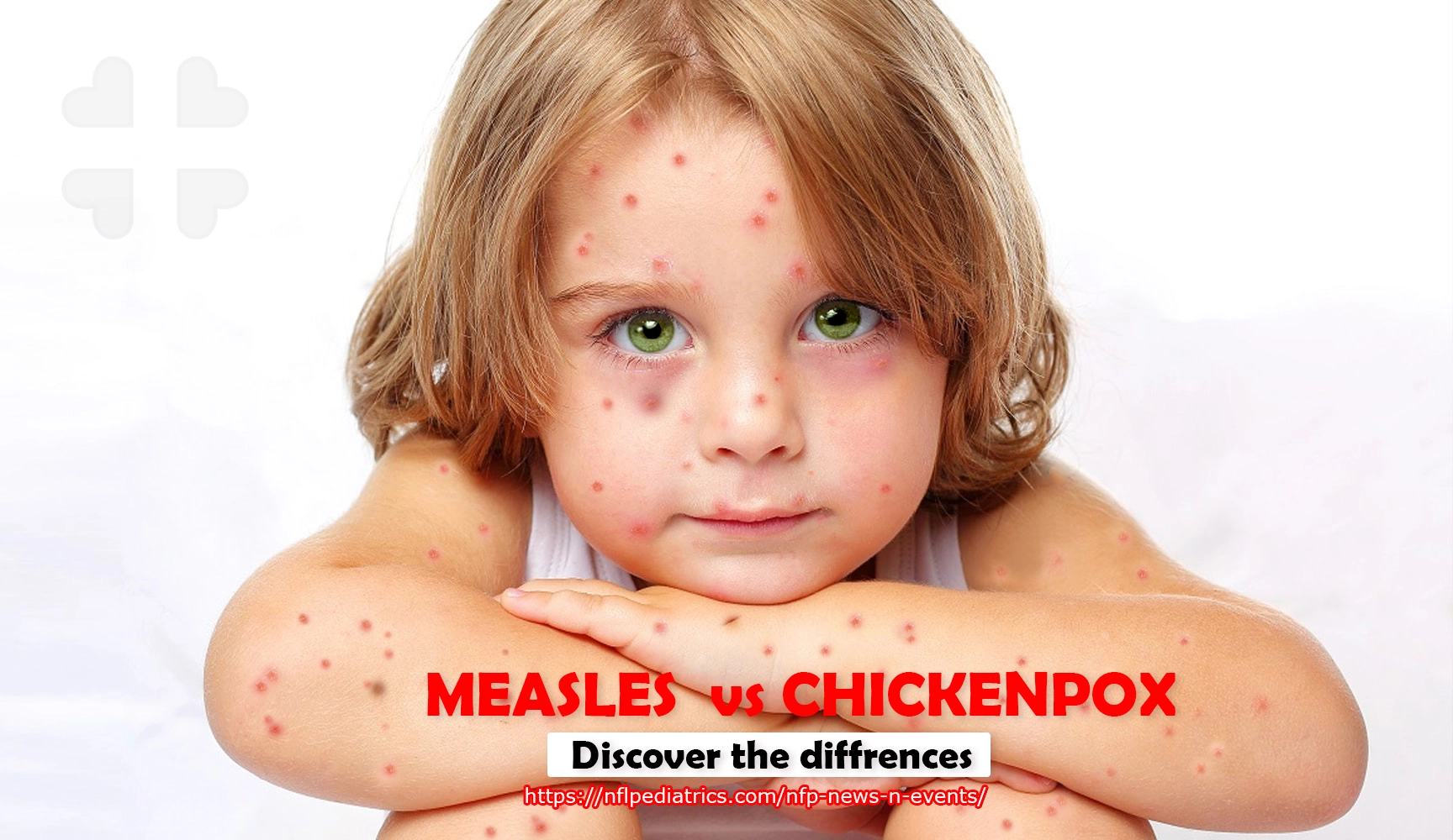 chickenpox-vs-measles+discover the differences+North Florida Pediatrics+near lake city,+mmr vaccines